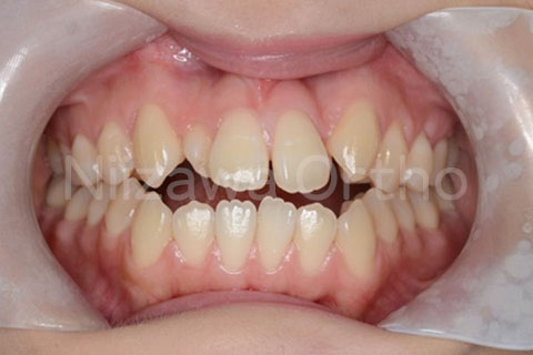 舌側矯正の治療例