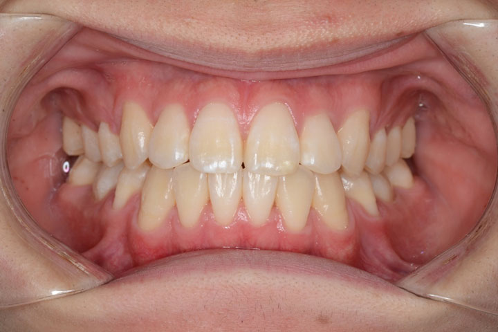 歯並びの種類と治療例