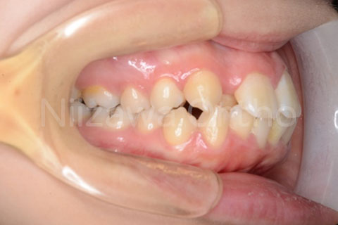 舌側矯正の治療例
